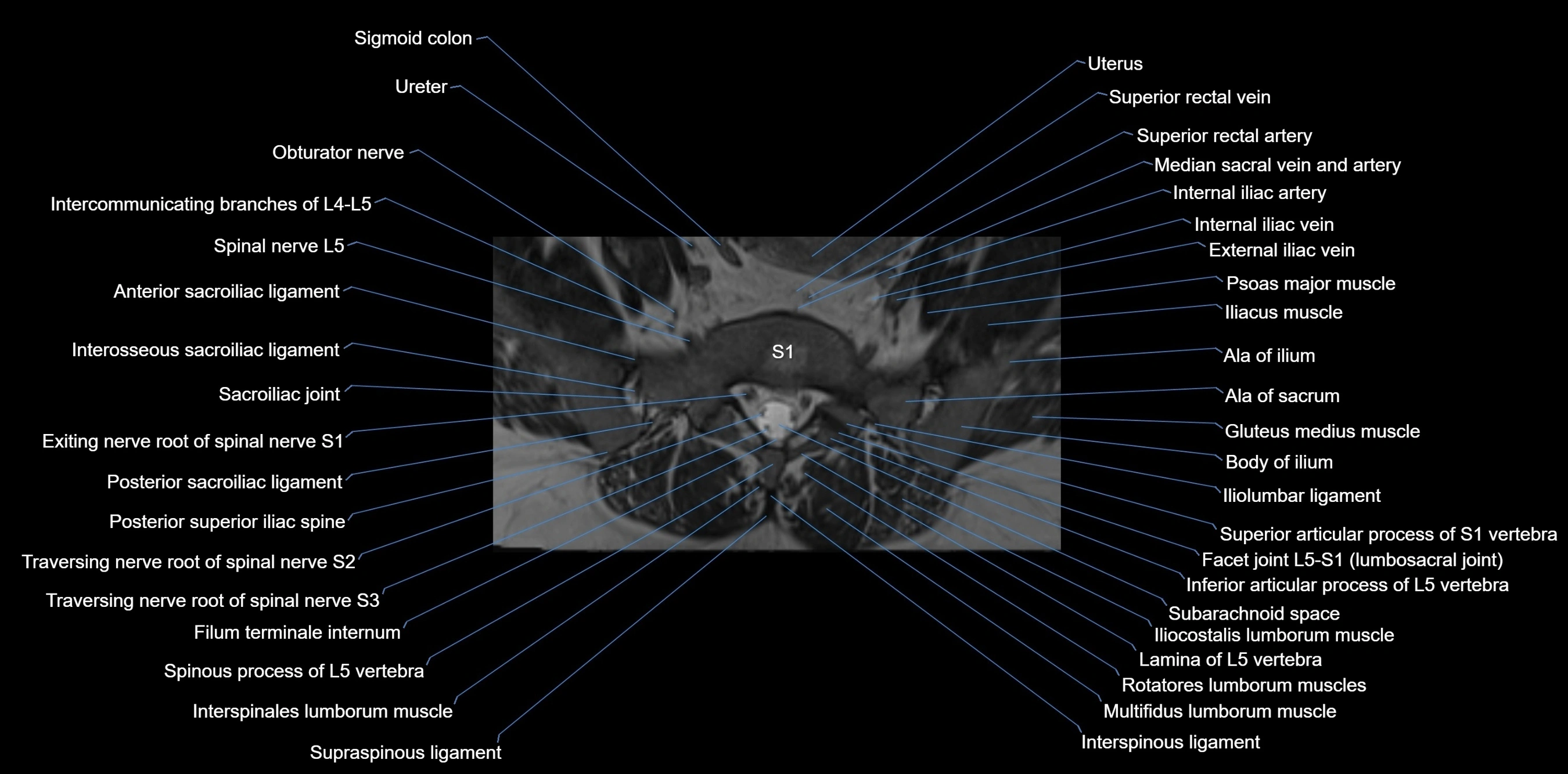 MRI sacrum, coccyx and sacroiliac joint axial cross sectional anatomy 3T  radiology  image-img-00001-00010.webp